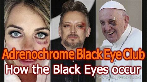 Adrenochrome black eye - Jul 15, 2022 · ADRENOCHROME/ THE BLACK EYE CLUB/ BILL GATES/ ELITES & RECENT NEWS https:// youtu.be/twnXZhOqhEI via @YouTube. learn from this video wake up world. youtube.com. 